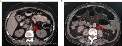 A nomogram to predict the risk of colorectal anastomotic leakage combining inflammatory-nutritional and abdominal aorta calcium index